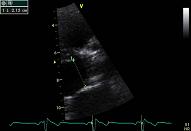Aortic valve, patient 3:3 - Combinated aortic vitium