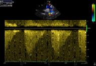Aortic valve, Patient 4:4 - Bicuspid valve, coarctatio