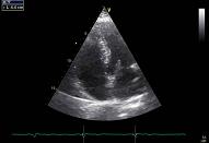 17 ASD or PFO, VSD, ductus\ASD el. PFO, VSD, ductus, patient nr 6:3