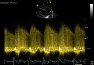 ASD el PFO, VSD, ductus, patient 3:2 - patent ductus arteriosus