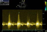 ASD el PFO, VSD, ductus, patient 1:2, small ventricular septal defect