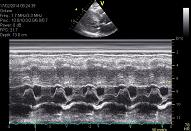 8 Cardiomyopathy\Cardiomyopathy, Hypertroph cardiomyopathy, patient nr 2-2