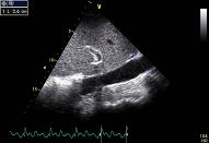 Embolism, patient 3 - Thrombosis in the pulmonary trunc