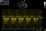 Embolism, patient 1:4 - Thrombosis in the pulmonary trunc