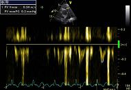 Embolism, patient 1:5 - Thrombosis in the pulmonary trunc