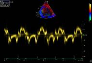 Restrictive, elevated filling pressure (patient 3:5, E/É)