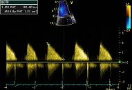 Mitral valve, patient 2:5 - Mitral stenosis