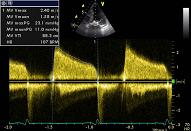 Mitral valve, patient 3:3 - Mitral stenosis