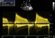 Mitral valve, patient 3:4 - Mitral stenosis