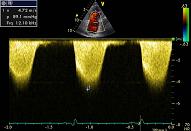 Mitral valve, patient 3:7 - Mitral stenosis