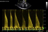 13 Mitral valve\Mitral valve, patient nr 5-2, mitral stenosis