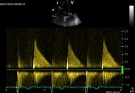 13 Mitral valve\Mitral valve, patient nr 5-5, mitral stenosis