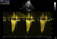 Pulmonal valve, patient 2:2 - Subvalvular membrane