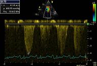 Pulmonary hypertension, patient 1:3 - PHT affecting RV and LV