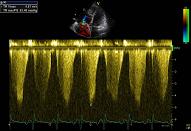 Pulmonary hypertension, patient 2:4 - PHT and dilatated RV