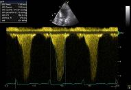 Subvalvular obstruction, hypovolaemi, patient 1:3 - Subvalvular obstruction SAM