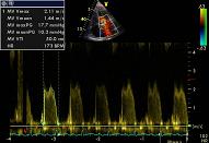 Thrombosis, tumor, vegetation, pat nr 7:3 (vegetation mitral valve)