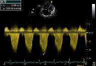 Tricuspid valve, patient 1:3 - Severe tricuspid regurgitation and pulmonary hypertension