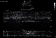 Tricuspid valve, patient 1:4 - Severe tricuspid regurgitation and pulmonary hypertension