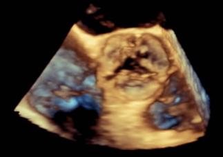 3D-echocardiograhic short axis view of a tricuspid aortic valve